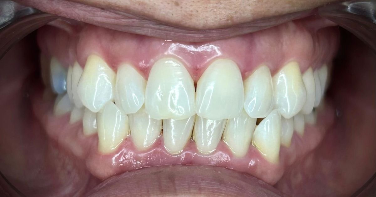 Blanqueamiento dental: el secreto para una sonrisa blanca, estable y duradera